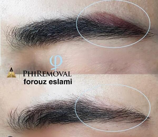عکس قبل و بعد لیزر تاتو ابرو