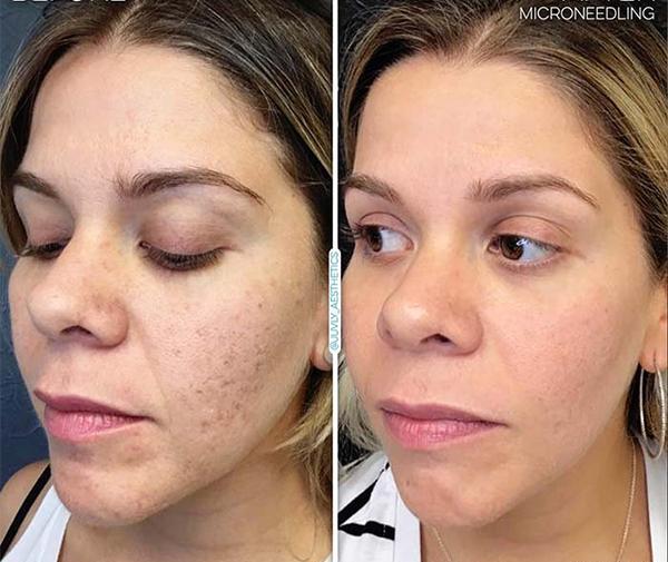 عکس صورت بعد از میکرونیدلینگ