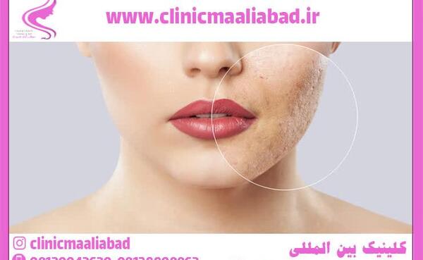 عکس صورت بعد از میکرونیدلینگ