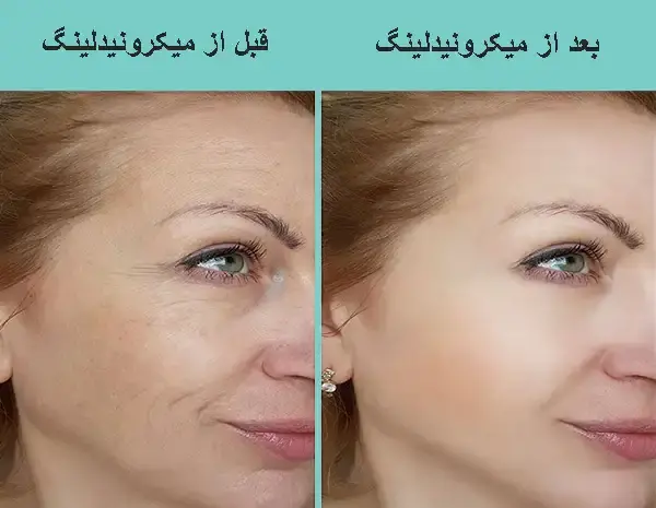 عکس صورت بعد از میکرونیدلینگ