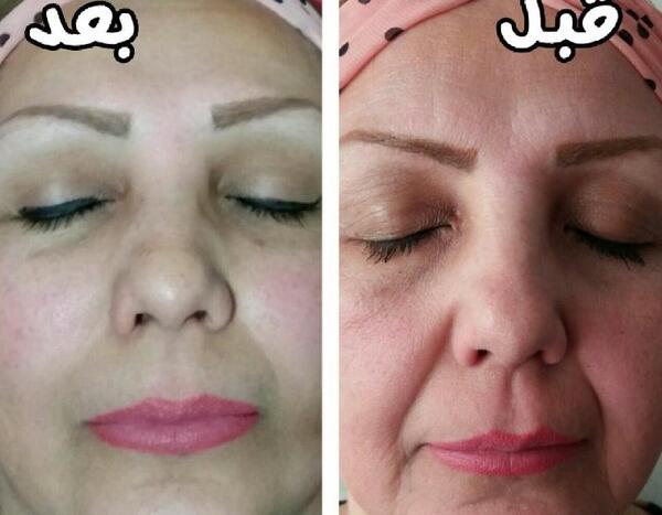 عکس صورت بعد از میکرونیدلینگ