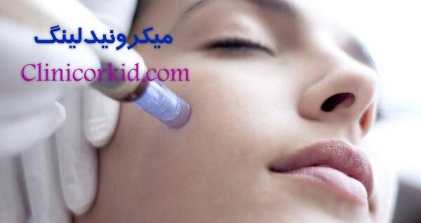 عکس صورت بعد از میکرونیدلینگ
