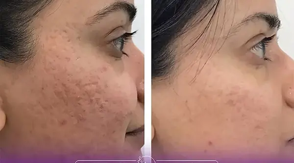 عکس صورت بعد از میکرونیدلینگ