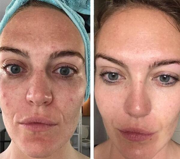 عکس صورت بعد از میکرونیدلینگ