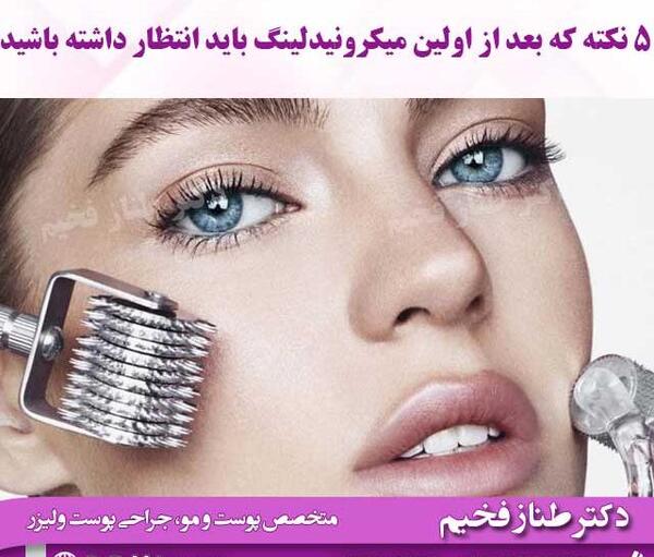 عکس صورت بعد از میکرونیدلینگ