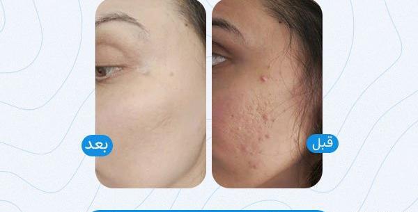 عکس صورت بعد از میکرونیدلینگ