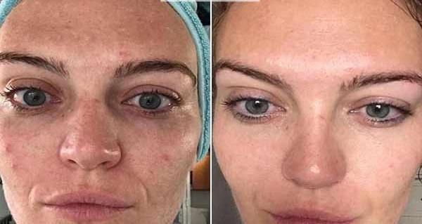 عکس صورت بعد از میکرونیدلینگ