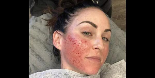 عکس صورت بعد از میکرونیدلینگ