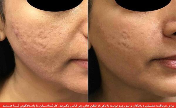 عکس صورت بعد از میکرونیدلینگ