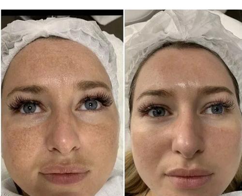 عکس صورت بعد از میکرونیدلینگ