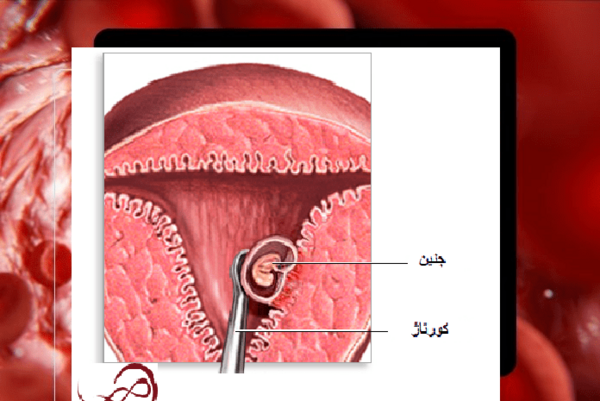 عکس جنین سقط شده پنج هفته ای پسر