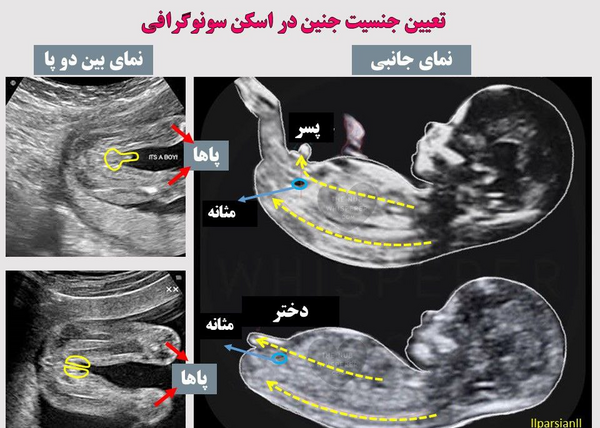 عکس جنین دختر در سونوگرافی هفته ۱۲