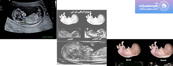 عکس جنین دختر در سونوگرافی ان تی