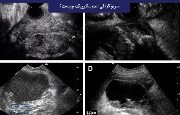 عکس جنسیت جنین دختر در سونوگرافی