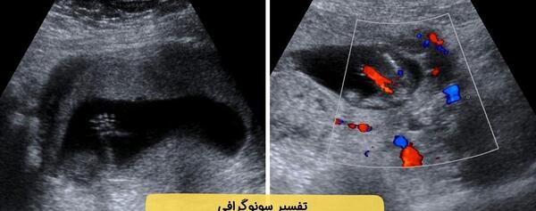 عکس جنسیت جنین دختر در سونوگرافی