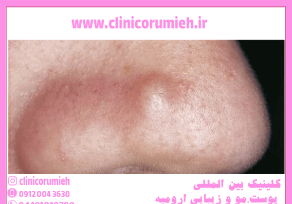 عکس انواع جوش