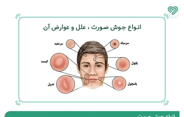 عکس انواع جوش