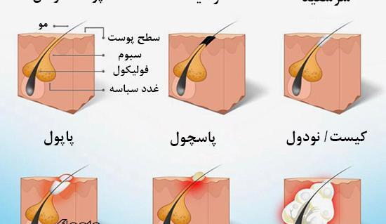 عکس انواع جوش