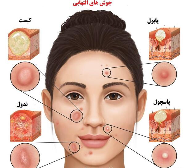 عکس انواع جوش