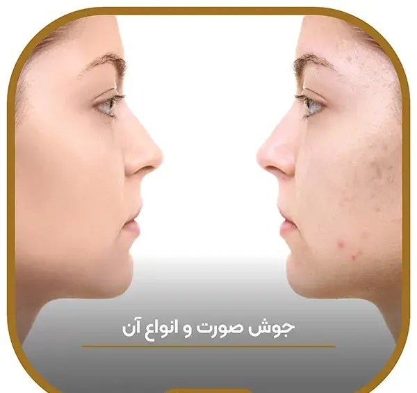 عکس انواع جوش