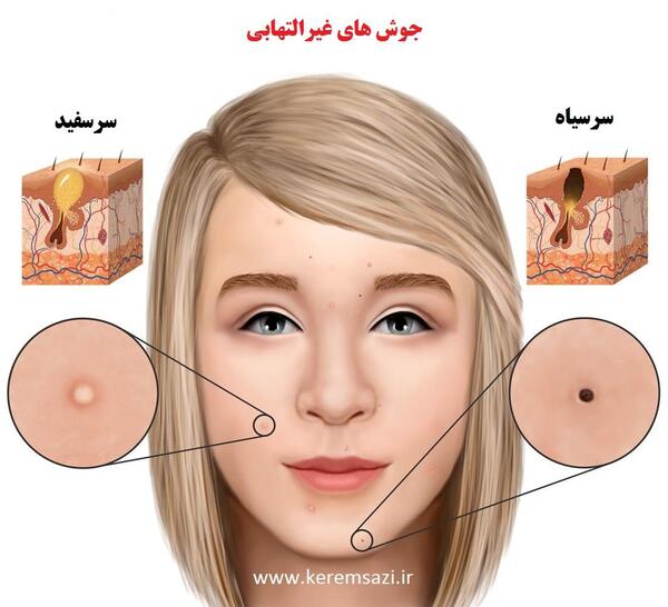 عکس انواع جوش