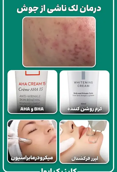 عکس انواع جوش