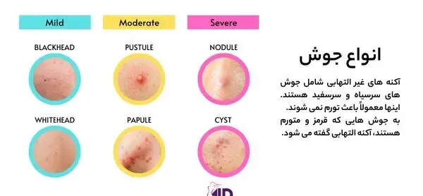 عکس انواع جوش در بدن کودکان