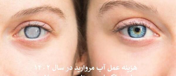 عکس از آب مروارید چشم