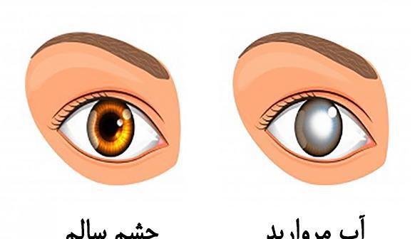 عکس از آب مروارید چشم