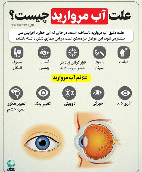 عکس از آب مروارید چشم