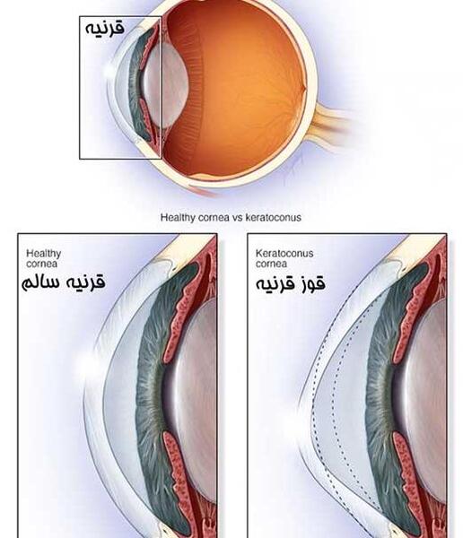 عکس قرنیه چشم چیست