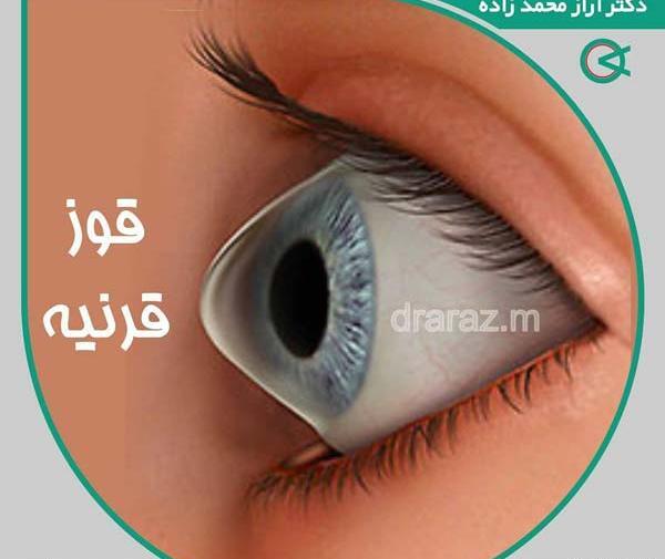 عکس قرنیه چشم چیست