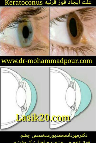 عکس قرنیه چشم چیست