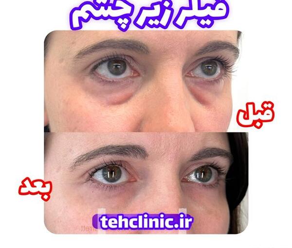 عکس ژل زیر چشم