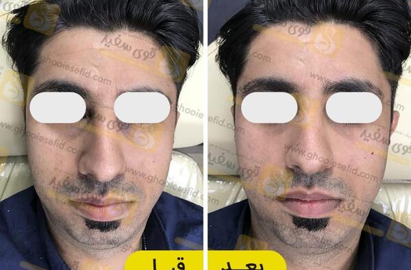 عکس ژل زیر چشم