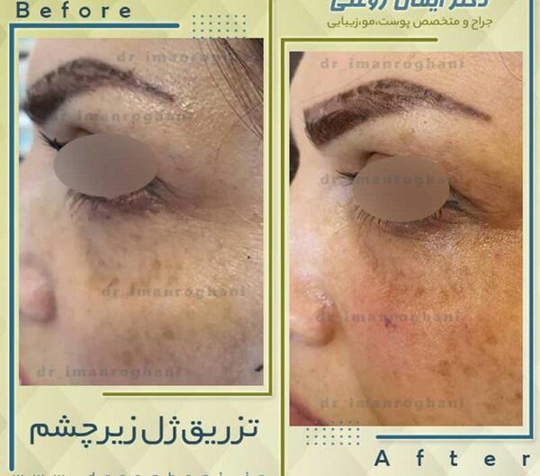 عکس ژل زیر چشم