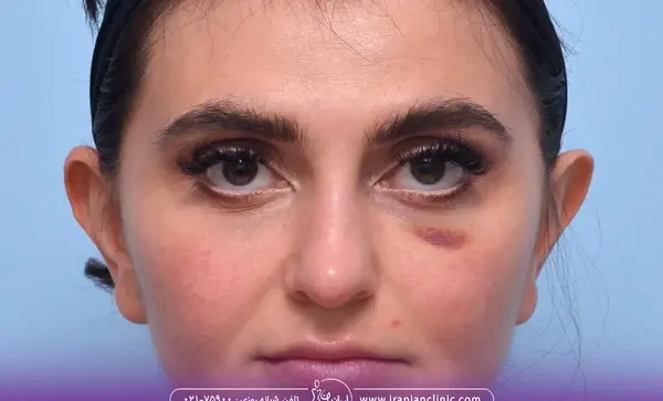 عکس ژل زیر چشم
