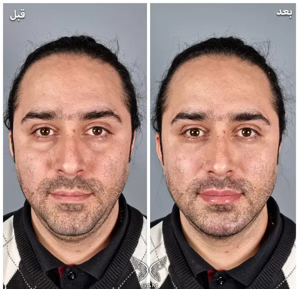 عکس ژل زیر چشم