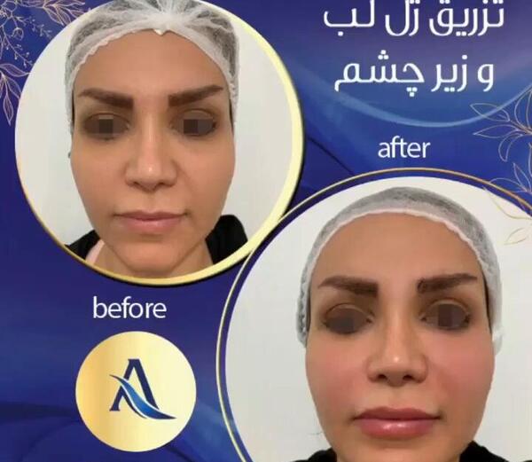 عکس تزریق ژل زیر چشم