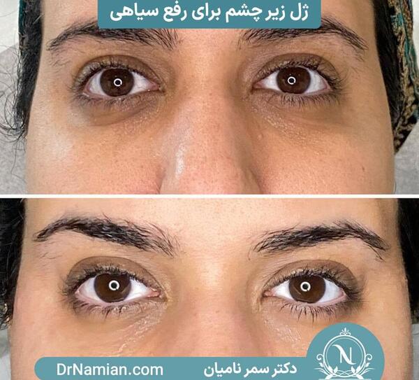 عکس تزریق ژل زیر چشم
