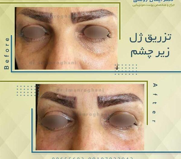 عکس تزریق ژل زیر چشم