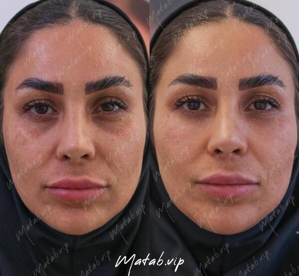 عکس تزریق ژل زیر چشم