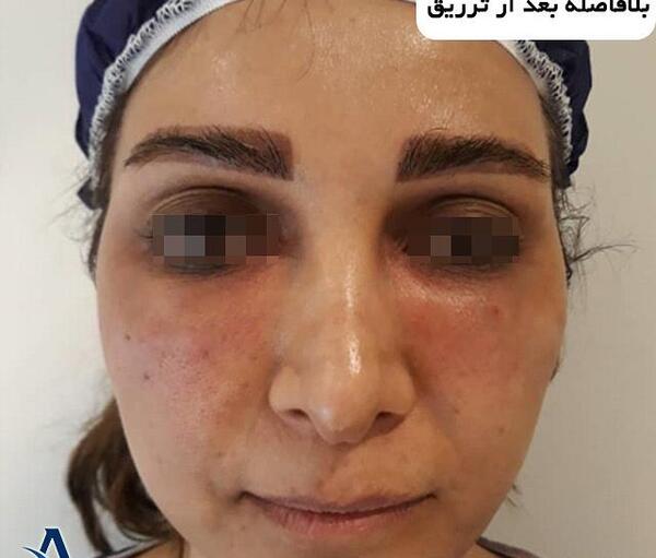عکس تزریق ژل زیر چشم