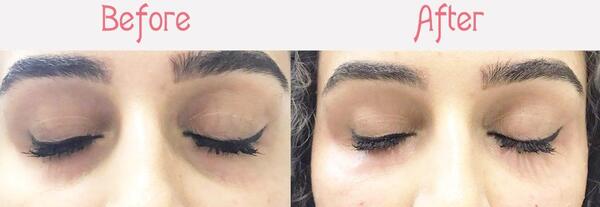 عکس تزریق ژل زیر چشم