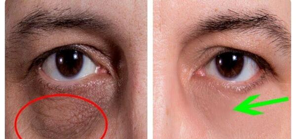 عکس تزریق ژل زیر چشم