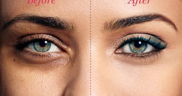 عکس تزریق ژل زیر چشم