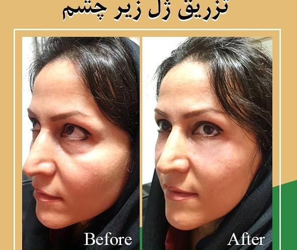 عکس تزریق ژل زیر چشم