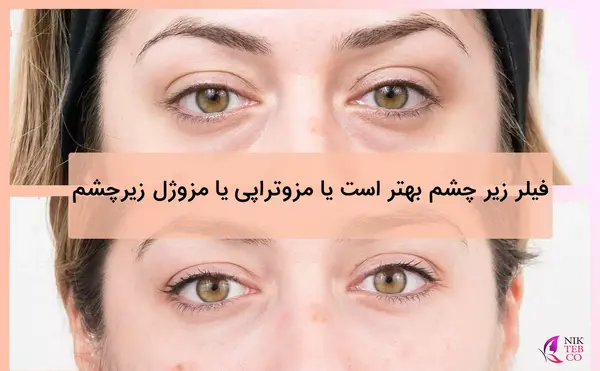 عکس مزو ژل زیر چشم