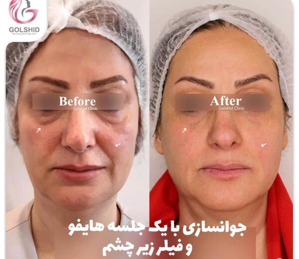 عکس مزو ژل زیر چشم