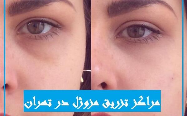 عکس مزو ژل زیر چشم